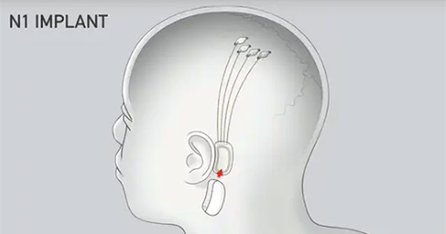 Khám Phá Tiến Bộ Trong Thử Nghiệm Cấy Chip Não Của Neuralink