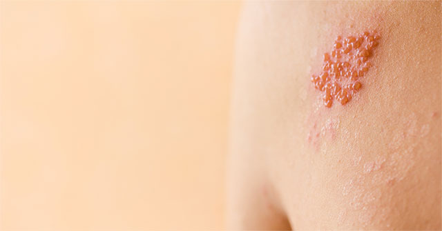 Hiểu Biết Về Bệnh Zona Thần Kinh: Triệu Chứng, Nguyên Nhân và Phương Pháp Điều Trị