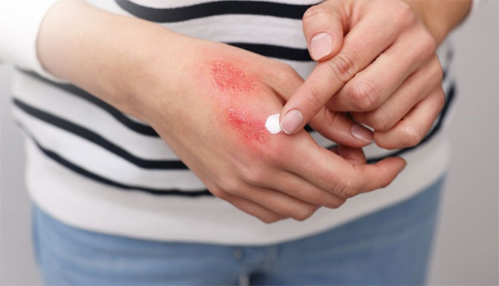 boi-kem-oxit Bôi kẽm oxit để giảm nhẹ triệu chứng do kiến ba khoang đốt