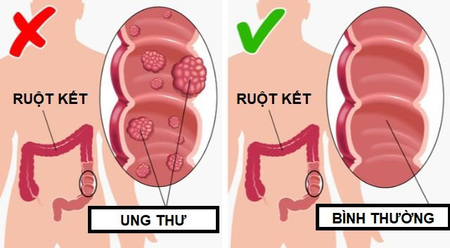 loi-ich-khi-an-dua-chuot-moi-ngay-2 Ngăn ngừa ung thư