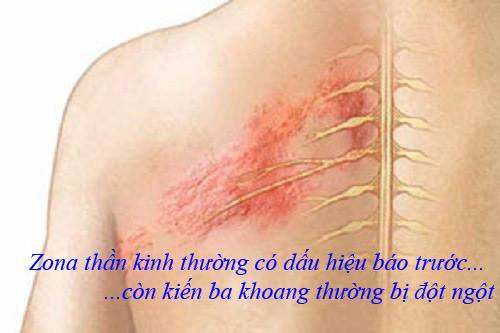 Tổn thương do kiến ba khoang gây ra thường xuất hiện đột ngột Tổn thương do kiến ba khoang gây ra thường xuất hiện đột ngột