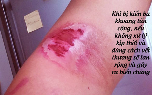 Nếu không xử lý kịp thời, kiến ba khoang có thể gây ra biến chứng Nếu không xử lý kịp thời, kiến ba khoang có thể gây ra biến chứng