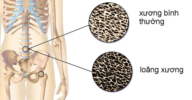 4 Loại Thực Phẩm Cần Tránh Để Giữ Gìn Lượng Canxi Cho Cơ Thể